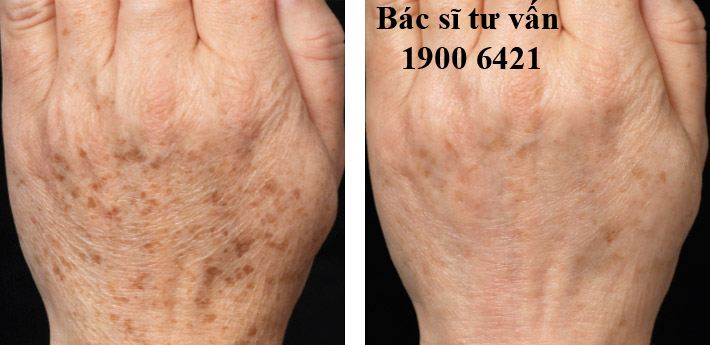 Cách chữa đồi mồi ở tay cach chua doi moi o tay