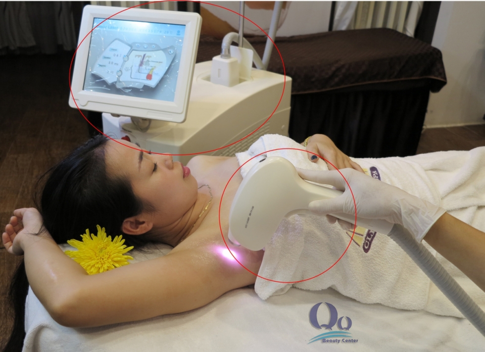 Tẩy lông nách bằng phương pháp tự nhiên Phương pháp triệt lông nách giá rẻ tại Hà Nội bằng công nghệ Diode Laser được đánh giá với nhiều ưu điểm vượt trội.