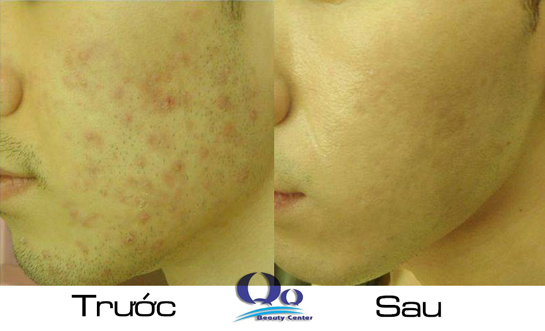 Cách trị mụn trứng cá cho nam giới hiệu quả hình ảnh 3 Cach tri mun trung ca cho nam gioi hieu qua hinh anh 3