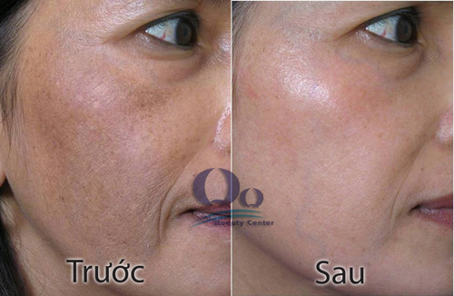 Điều trị đồi mồi bằng công nghệ cao hình ảnh 2 Dieu tri doi moi bang cong nghe cao hinh anh 2