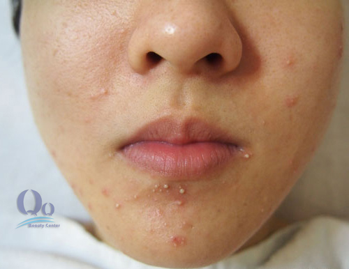 Điều trị mụn cám hiệu quả nhất hình ảnh Dieu trị mun cam hieu qua nhat hinh anh