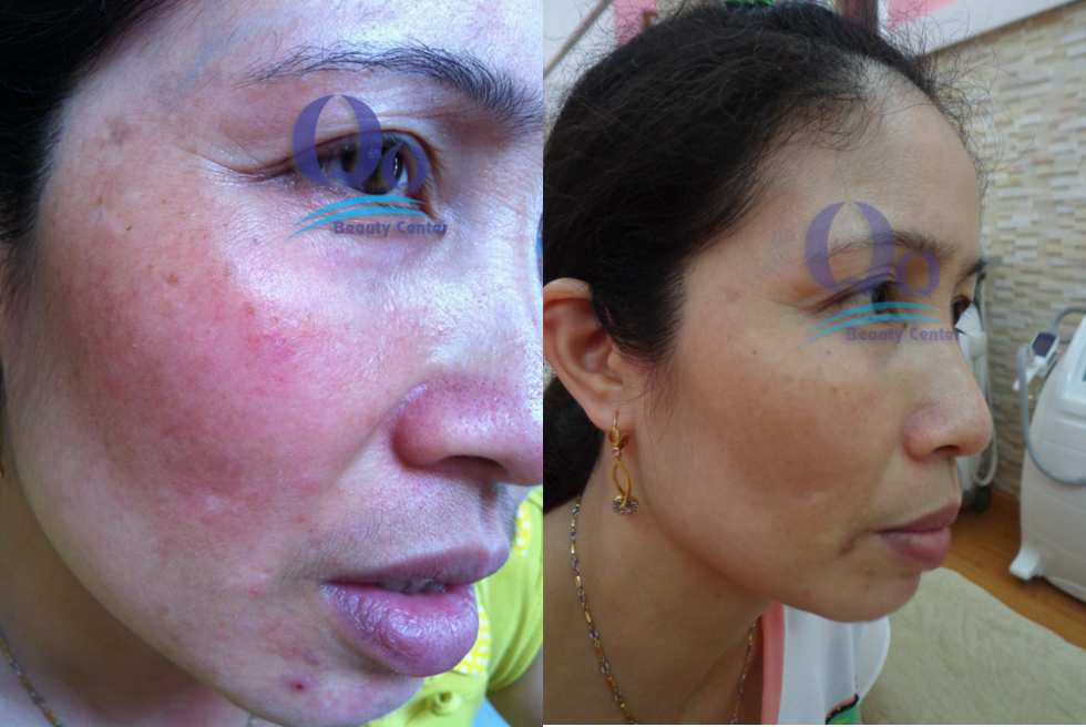 Điều trị viêm da dị ứng hình ảnh Dieu tri viem da di ung hinh anh