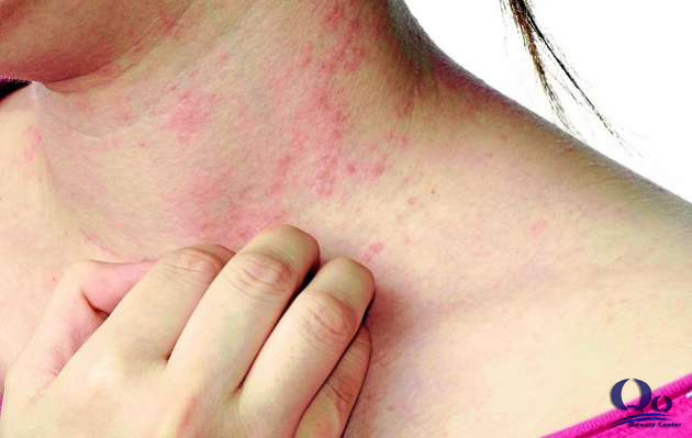 Điều trị viêm da dị ứng