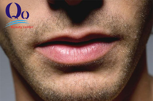 Tẩy thâm môi bằng laser cho nam